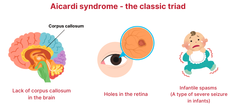 Aicardi syndrome classic triad includes missing of the corpus callosum in the brain, holes in the retina, and infantile spasm (a type of severe seizures in infants).