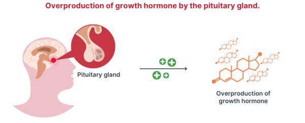 Acromegaly is caused by overproduction of growth hormone by the pituitary gland.