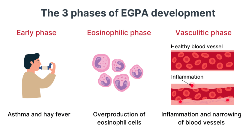 The three phases of EGPA development. First "early phase" characterised by asthma and hay fever. Second "eosinophilic phase" characterised by overproduction of eosinophil cells. Third "vasculities phase" characterised by inflammation and narrowing of blood vessels.