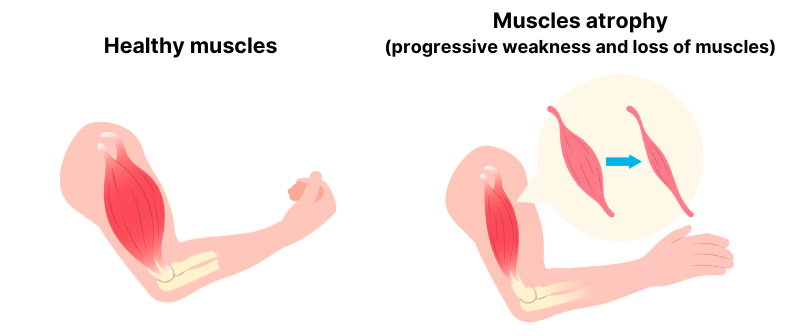 Illustration depicting the differences between healthy muscles and muscles atrophy which is the progressive weakness and loss of muscles.