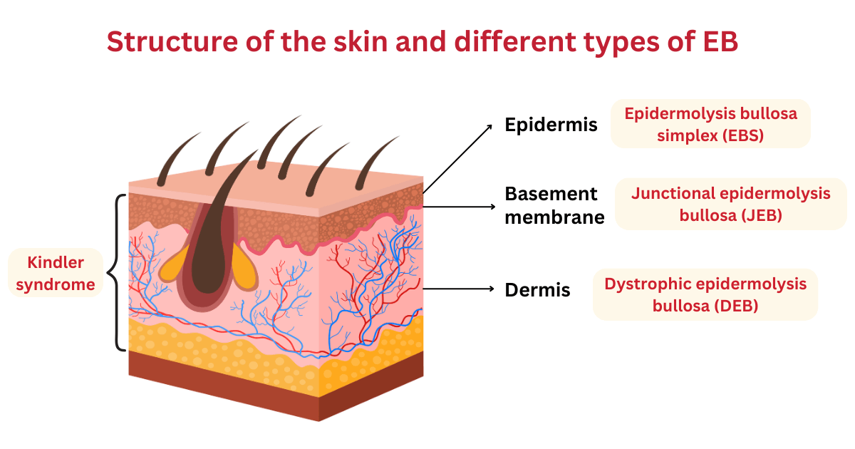 Layers of the skin from the surface to below are epidermis, basement membrane and dermis. Different subtypes of EB affect different layers of the skin.